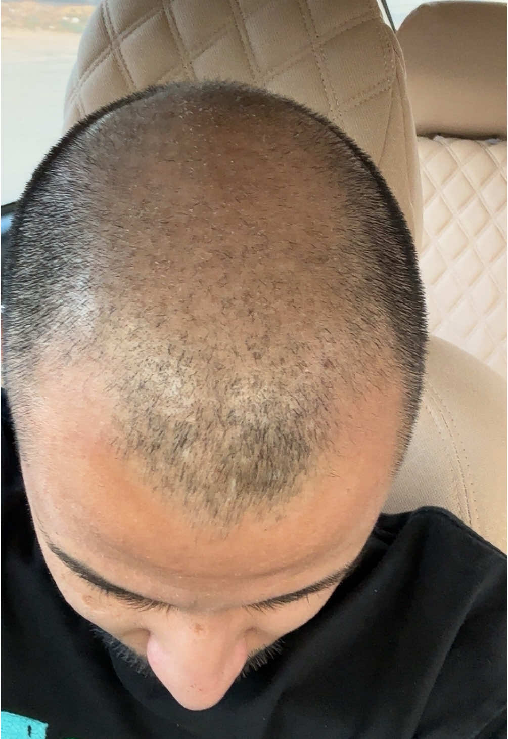 احد يحتاج مساعدة ل تساقط شعره ! #حايل #تساقط_شعر 