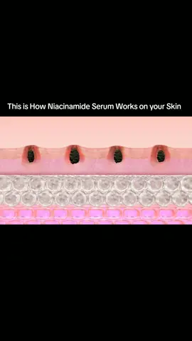 Niacinamide is a powerful beta-hydroxy acid (BHA) known for its ability to penetrate deep into the pores, effectively exfoliating and breaking down the bonds that hold dead skin cells together. This promotes the shedding of old skin and helps to clear clogged pores, reducing the appearance of acne, blackheads, and whiteheads. Additionally, its anti-inflammatory properties soothe the skin, making it ideal for oily and acne-prone skin types. #SalicylicAcid #Exfoliation #Acne Treatment #BHA #Skincare Science #HealthySkin #PoreCare #Skincare Routine #Acne Solutions #ClearSkin #Exfoliate #SkinCare #SkincareIngredients #BeautyRoutine #OilySkinCare #AntiInflammatory #SmoothSkin #GlowUp #SkinHealth #CleanSkin #AcneFree #SkincareTips #HealthyGlow #BeautyScience #PoreMinimizing #Dermatology #SkinCareScience #SkinCareCommunity #BeautyCommunity #effectiveskincare 