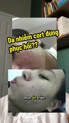 Nếu bạn đang có cái da mụn nhiễm corticoid đỏ, mỏng, yếu, và vẫn loay hoay không biết làm sao để da khỏe mạnh trở lại, thì ngay lúc này, hãy dành vài phút thôi, để nghe thật kỹ những gì mình sắp nói dưới đây, vì chỉ cần các bạn khắc phục đc cái sai lầm tai hại này, các bạn sẽ thay đổi toàn bộ tư duy về phục hồi da nhiễm cort. #olililaofficial #treatment #mụn #trimun #skincare #trịmụn #corticoid #cort #