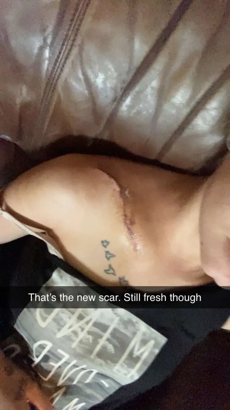 I’m gonna have a pretty gnarly scar