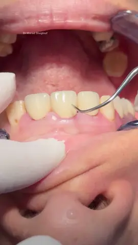 Replace old metal porcelain bridge with new zircon after restoring the teeth #dentist #dental #dentistry 