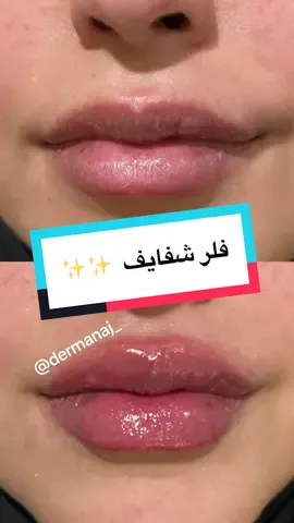 • امتلاء طبيعي لشفايف مدخنة يحتاج فلر كثافة اعلى عشان يبقى فترة اطول. #الشعب_الصيني_ماله_حل😂😂 #الرياض #اكسبلور #ترند 