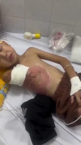 Bé bị bỏng điện giật khi cố lấy diều mắc vào dây điện  #xh 