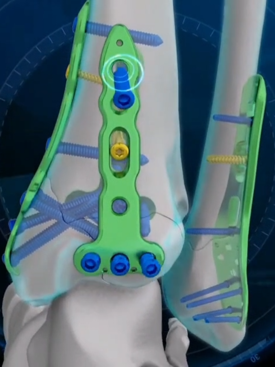 #communityfest2025 fracture #technique #ortopedia#bone structure