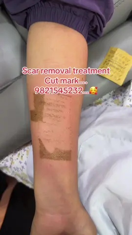 #scar #daag #pigmentation #weinkles #acnetreatment #skincare #pigmentation #acne #daaag #skincare #acnetreatment #fyppppppppppppppppppppppp #foryoupage #goviral 