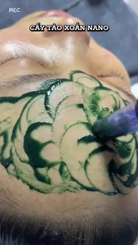 🌿🌿🌿 Cấy tảo  có tác dụng gì? - Cấp ẩm cho da, với hàm lượng dưỡng chất dồi dào và đa dạng, tảo xoắn khi cấy vào da sẽ hỗ trợ cấp ẩm, nuôi dưỡng sâu, thu nhỏ lỗ chân lông.... Giúp làm sạch sâu các lỗ chân lông. ... se khít lỗ chân lông.... rút ngắn chu kỳ tái tạo da. ... hỗ trợ làm đều màu da. #cấytảoxoắnnano #Chămsócdachuyênsâu #spacáibè #cấy_trắng_da #cấpẩmchuyênsâu #beautyspa