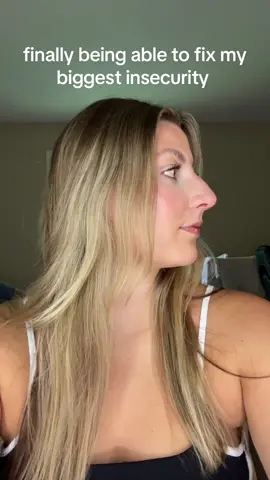 I’ve hated the bump on my nose since I was 10. Here we are 15 years later and she’s gone. I can’t wait to see the final product once the swelling has gone down, but it already looks so much better! #fyp #rhinoplasty #nosejob 