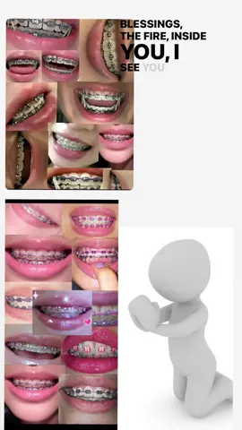 2025 goals 😫#braces #fypシ 