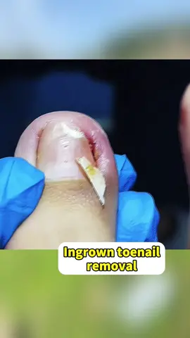 Ingrown toenail removal #ingrowntoenail #ingrownnailremoval #toenailremoval #viralvideo #podologia #pedicure #foryou #fyp