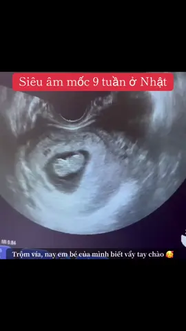 Lần thứ 3 khám thai ở Nhật. (9w4d) Nay mình dc làm xét nghiệm máu, nước tiểu, và siêu âm. Chi phí tổng hơn 1m6. Trộm vía mình đã có kupon của shi (sd hết 6 phiếu là 1m5). Nên mình chỉ cần đóng hơn sen thôi. NB đáng yêu quá 🥰🥰🥰 #hanhtrinhlamme #mangthaionhat #xuhuong #fypシ゚viral #thinhhanh #lầnđầulàmmẹ 