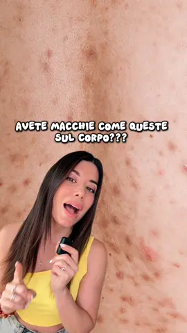 Avete macchie come queste sul corpo??? Vi consiglio 👉🏻 Mixa Niacinamide Bright, una crema idratante ANTI MACCHIE perfetta per viso corpo e mani!  Ha un OTTIMO rapporto qualità-prezzo e si trova OVUNQUE, anche al supermercato!🙌 sono sicura che diventerà la vostra bff 🫶🏻  #mixa #adv #skincare #bodycare 