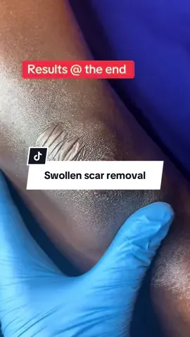 Book appointment for scar removal call 0742785221#trendingvideo #skincare #dermatologist #keloidremoval #scars #AfricanSports #foryoupage #dermatology @DR KAPTEN DERMATOLOGIST🇺🇬 @Esta skin therapist 2021 