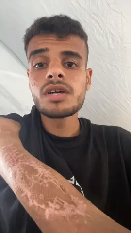 Save Mahmoud and his hand ‏#fyp #fup #viral #foryoupage #govirall #fypsy #fypg #fyyyp #frp #kids #business #fyyy #f #fyp #foryou ##foryoupage #fypppppppppppppppppppppppppppppppppp #viral #water #Home #food #job #usa #indonesia #dubai🇦🇪 #unfrezzmyaccount #support_me #dubaichocolate #foryou #fypシ #foryoupage #viralvideo #trend #explore #Love #support #helpme #life #family #saveus #tiktok_arab #palestine #rebuild #hope #future #dubai #usa #indonesia #tiktok #tiktokviral #fypdaily #momlife #baby #reallife #savelives #war #refugees #recovery #motherhood #voice #gaza #prayforus #helpnow #emergency #humanity #peace #rebuildhope