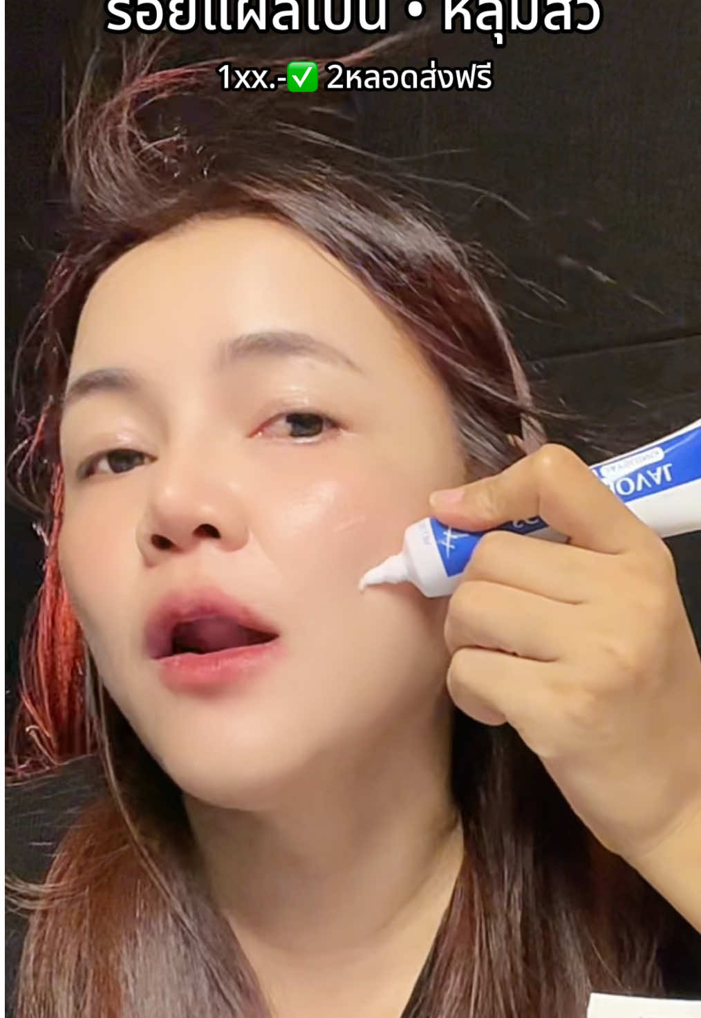 2หลอดส่งฟรี ปัญหาหลุมสิว รอยแผลเป็นลึก ตัวนี้เอาอยู่ #หลุมสิว #รอยแผลเป็น #รอยสิว #ผิวไม่เรียบเนียน #การดูแลผิว #ครีมซ่อมผิว #บ๋อมที่เป็นหมออนามัย 