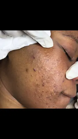#pourtoisenegal🇸🇳🇸🇳🇸🇳 #bevabeauty #acne #extraction #comedon #