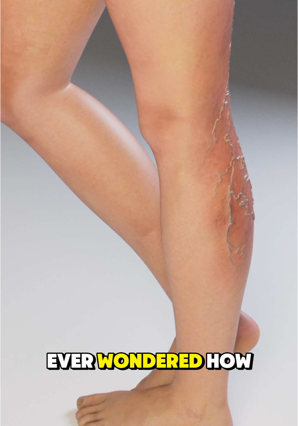 Treating Varicose Veins With Laser! (3D Animation) #varicoseveins #varicoseveintreatment #varicosetreatment #varicoseveinremoval #medical3danimation #3dmedicalanimation 