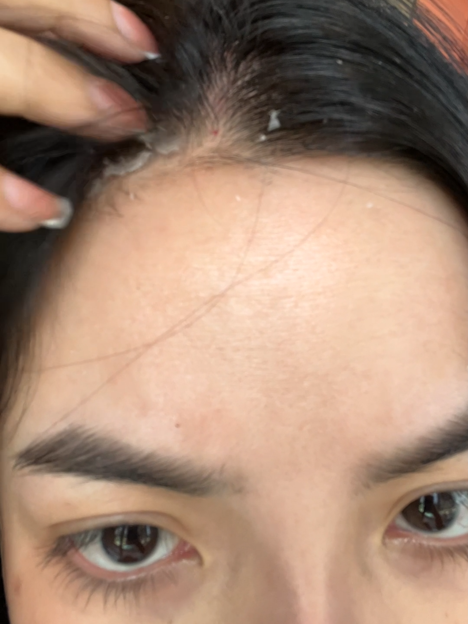 Gàu ngứa thì gội ngay, nấm da đầu thì thoa ngay - Kết quả vài ngày (tùy cơ địa), đặc biệt không hề khô tóc chị em nhé! #biocarepharma #daugoitrigau #namdadau #trigau