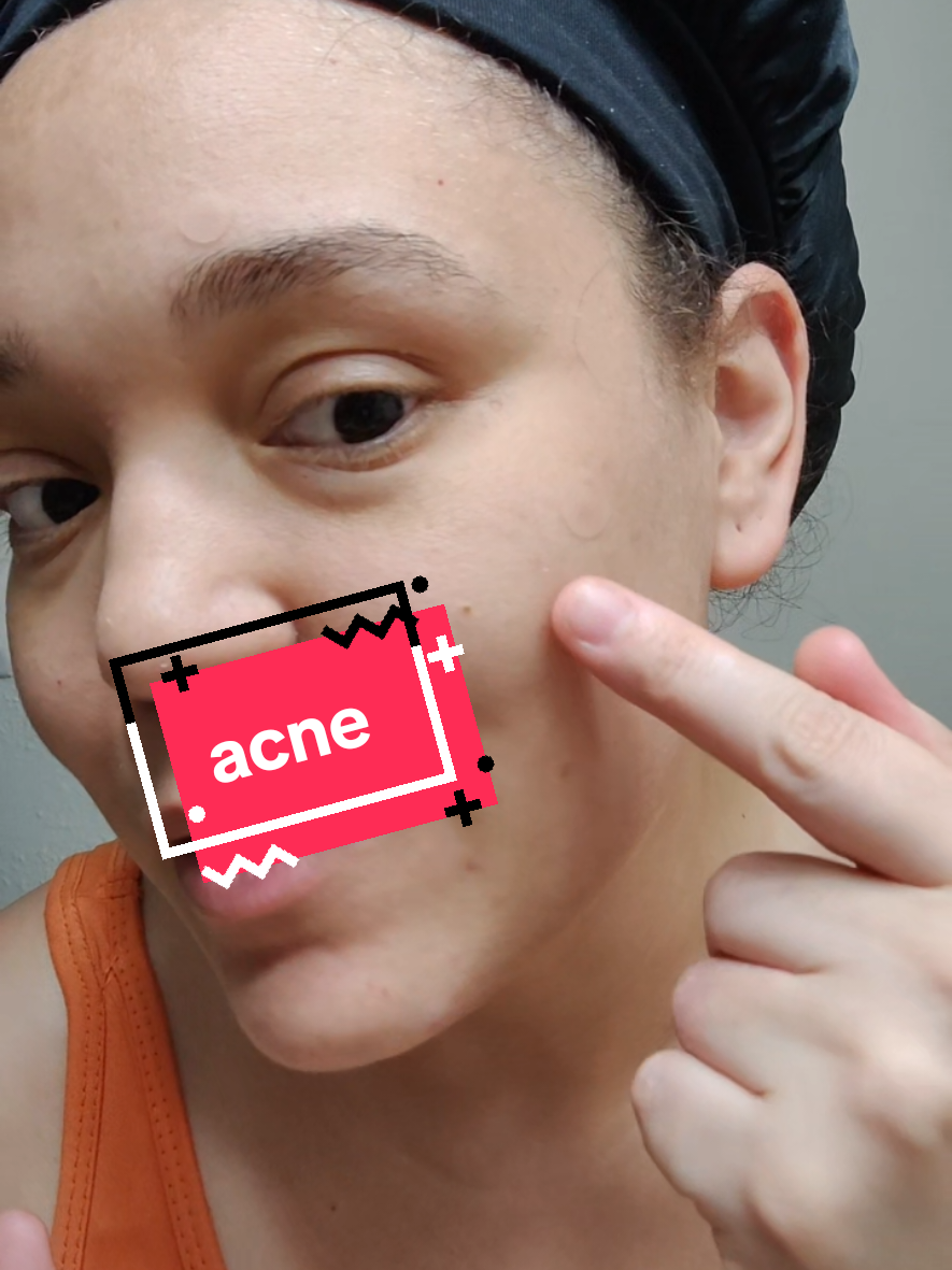 Do you see that acne patches #acnepatches #pimples #acneproneskin 