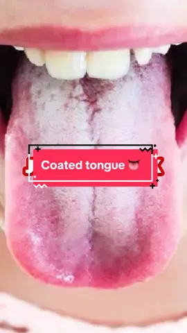 Coated tongue jangan dibiarin ya beb! Bersihin lidah kalian sekarang pake Lumint 🥰💕 #viral #fyp #sikatgigi #kesehatan #doktergigi #baumulut #gigikuning #gusiberdarah #lidahputih #kesehatanmulut #gigibersih 
