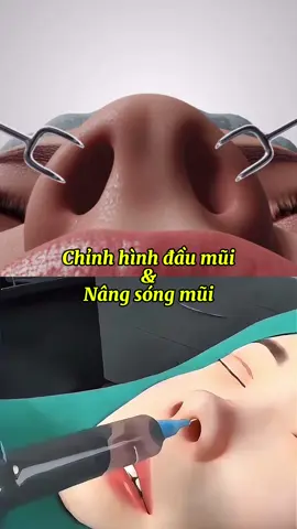 Yếu tố đầu tiên làm mũi đó là phải đúng phương pháp. Đầu mũi đẹp, sóng thấp thì nâng sóng không can thiệp đầu mũi. Sóng cao, đầu mũi lỗi, thì chỉnh hình đầu mũi. Chưa đẹp ở đâu, chỉnh sửa ở đó