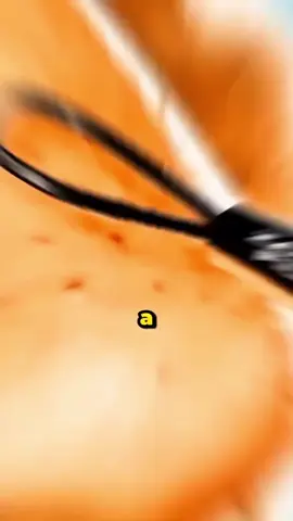 Cuidadooo!  #fyp #viralvideos #humor #information #info #espinhas #cravo #pele #dermatologist #dermatologo 