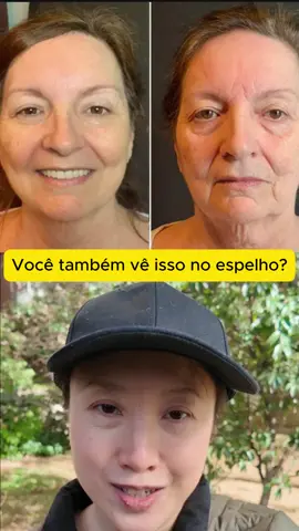 O site do tratamento está aqui na biografia! #envelhecimento #pelesaudavel #terceiraidade #dicasdebeleza #envelhecimentosaudavel #retinol #skincare #rugas