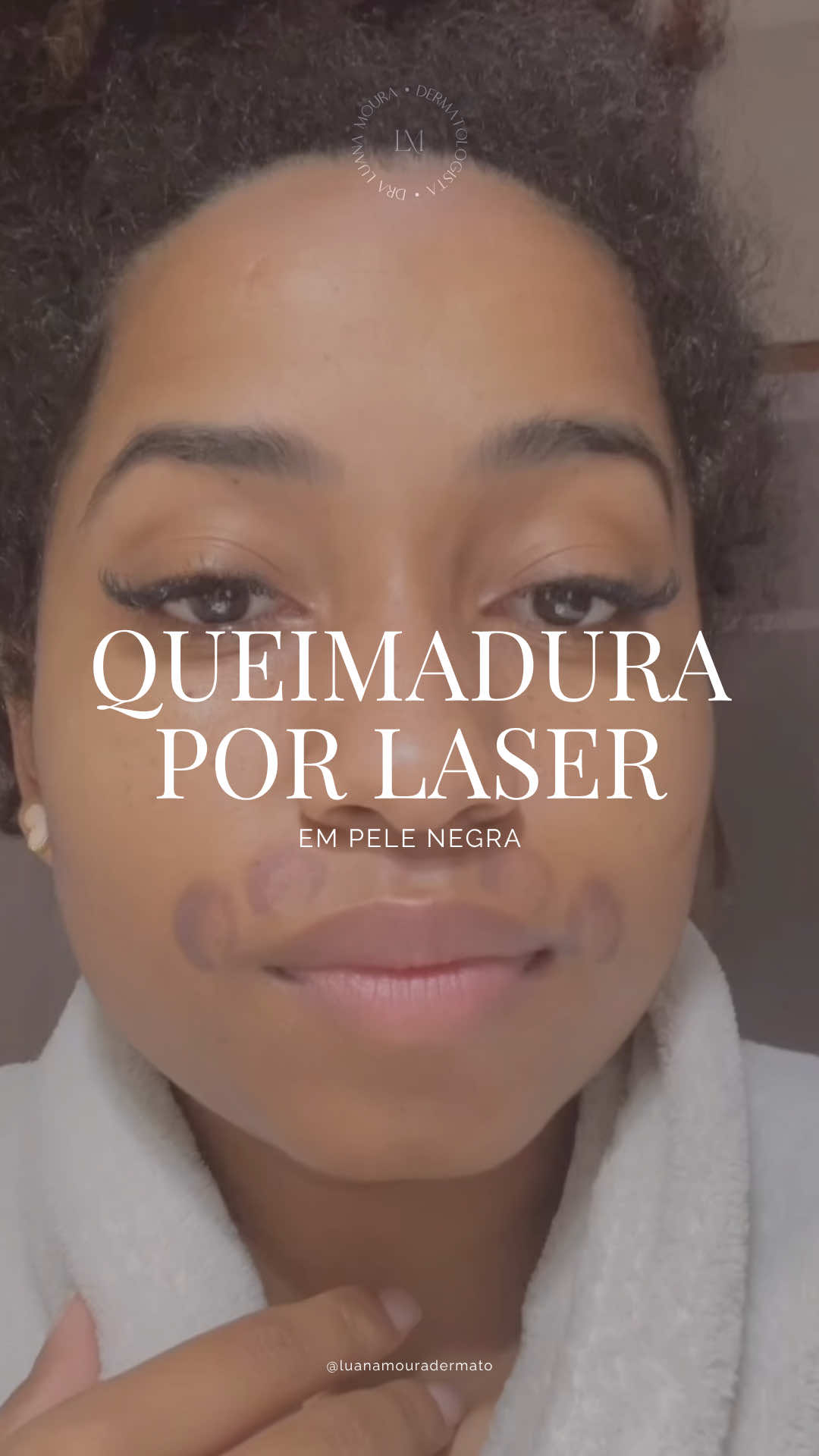 Queimadura por laser em pele negra #creatorsearchinsights #laserhairremoval #skinofcolor #blackskin #blackskincare #pelenegra #queimadura #lasertreatment #laserhairremovaltreatment #lasercomplication 