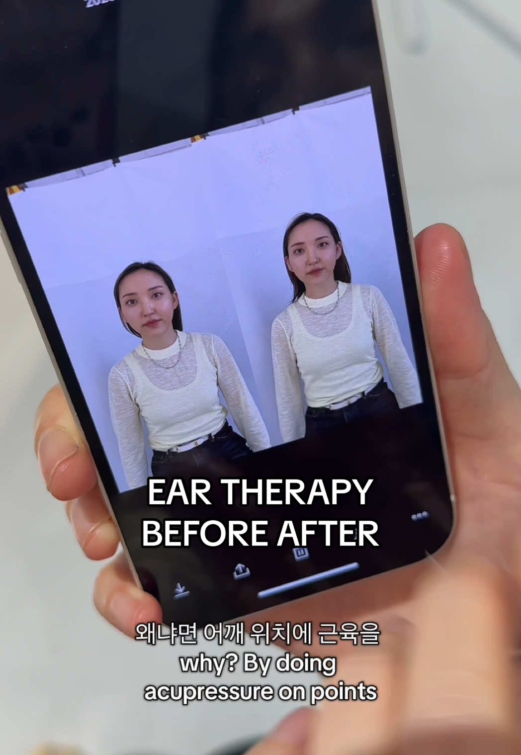 the most underrated treatment you can do… and it all happens in the ear. pain depends on how much imbalance there is in your body. you guys have to experience it for yourself because it is WILD 🤯 #eartherapy #earseeds #jelloskin #wellness #holistichealth #tcm 