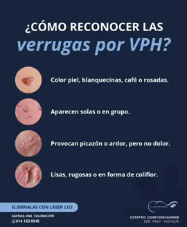 🔍 Las verrugas genitales por #VPH pueden pasar desapercibidas, pero su presencia indica una infección activa que requiere seguimiento ginecológico. Aunque algunas desaparecen solas, otras se mantienen o crecen, especialmente si hay factores como defensas bajas, cambios hormonales o lesiones previas. ¿La buena noticia? 😉 Hoy pueden eliminarse de forma ambulatoria con #vaporización láser CO2 ginecológico, un tratamiento eficaz, rápido y sin bisturí.  Este procedimiento remueve la lesión de raíz, disminuyendo el riesgo de recurrencia y cuidando el tejido sano. · 🩺 Dr. Oscar Martínez Rascón 📲 Agenda tu sesión por WhatsApp ➡️ wa.me/526141230545 🏥 Hospital Vistas del Sol | Consultorio 130Blvd. CNI Sur 1201 | #Delicias, Chih. · #VerrugasGenitales #LáserCO2 #Ginecología #Ginecólogo #SaludÍntima