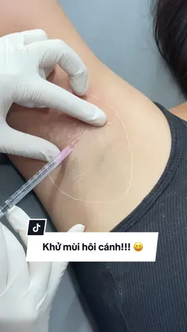 Dịch vụ hót nhất khi vào hè chị em đã biết tới chưa!#moibaby #botox #filler #tiemcam #tiembap #xuhuong #trending #capcut #moitay #tiemmoifiller #sohibeauty #tiemnach #hoinach #trihoinach #khumuihoinach 