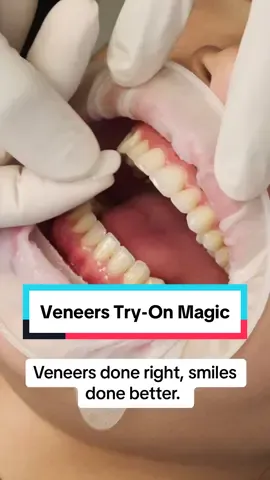 From try-on to transformation, watch as we preview the smile and then bring it to life ✨ There’s nothing like seeing our patients light up with confidence. Veneers done right, smiles done better. #veneers #dentist #drtejaspatel #cosmeticdentistry #beforeandafter #before #after #smiletransformation 