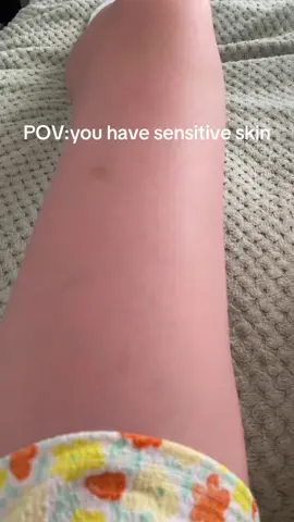 Seriously #sensitiveskin 