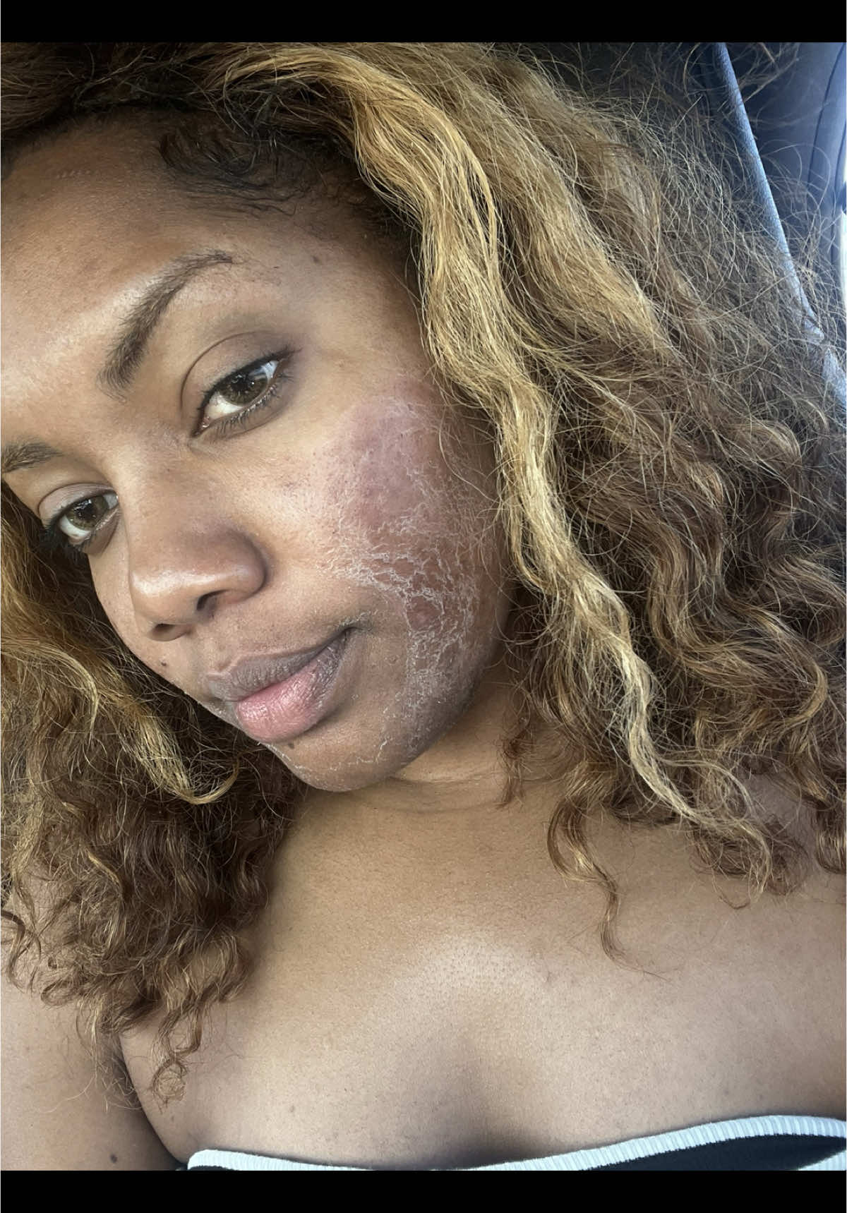 Chemical peel at home. #tretinoinjourney #kojicacid #hydroquinonecream #hydroquinonetretinoin #acneproneskin #acnescars #acnetreatment 