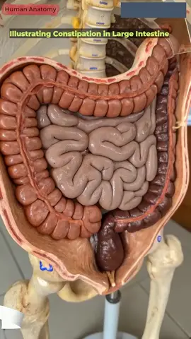 Illustration of Constipation Animation | Gut AI Art | 04#ConstipationAwareness #MedicalAnimation #DigestiveHealth #AnatomyEducation #ColonHealth #aff 