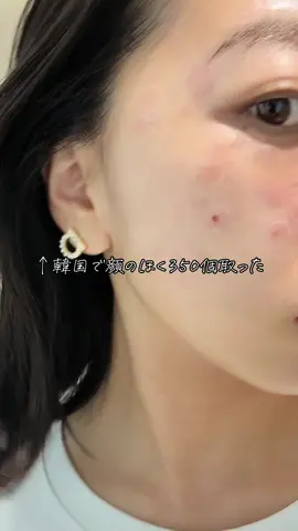 韓国でホクロとってきた☺️ 私の投稿みて、予約で特典あるのでインスタみてね💞 #ほくろ除去 #韓国皮膚科 #渡韓 