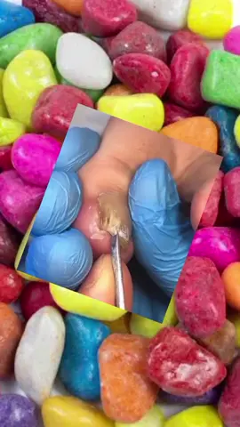 hummm #unhasdecoradas #unhaencravada #unhas #ingrowntoenail 