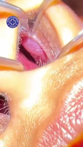 🏥ព្យាបាលបញ្ហារក្នុងច្រមុះ សុភាដុះសាច់ច្រមុះ ឬសដូងច្រមុះ អាឡែកហ្សុីច្រមុះ វៀចឆ្អឹងច្រមុះ និង រលាកច្រមុះ ដោយមិនអោយពិសារថ្នាំ រឺ បាញ់ស្ព្រៃ ច្រមុះទេ។ 👉 តម្លៃព្យាបាលត្រឹមតែ $50ប៉ុណ្ណោះ          ☎️ Tel: 0887555461