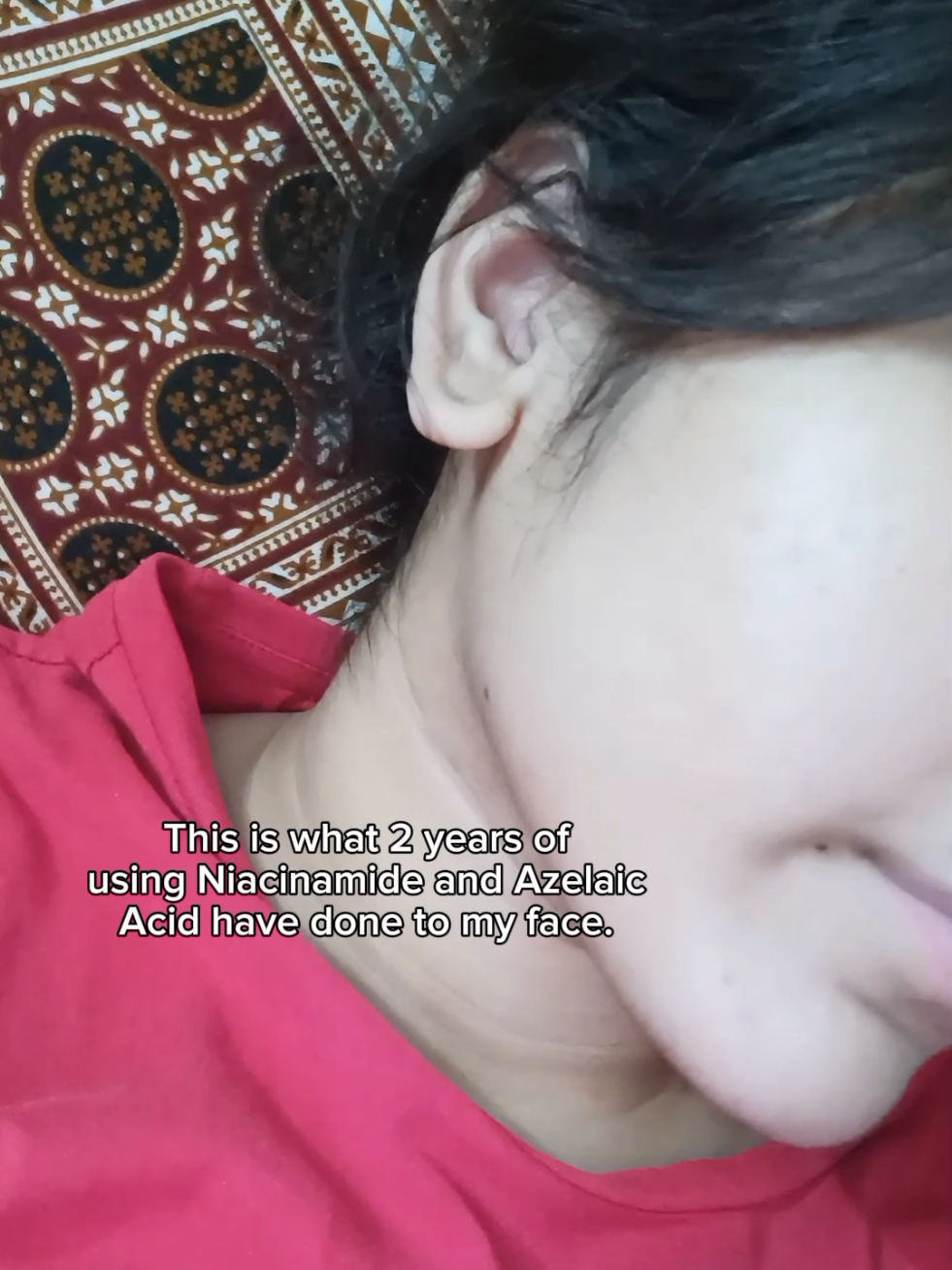 Should use some on my neck to i guess😭 . . . #facemask #mask #Summer #pores #shrink #skinbarrier #ugc #foryoupage #foryou #skincare #skincareroutine #skincaretips #goodproduts #ugccreator #like #follow #views #azelaicacid #niacinamide  #azaleicacid 