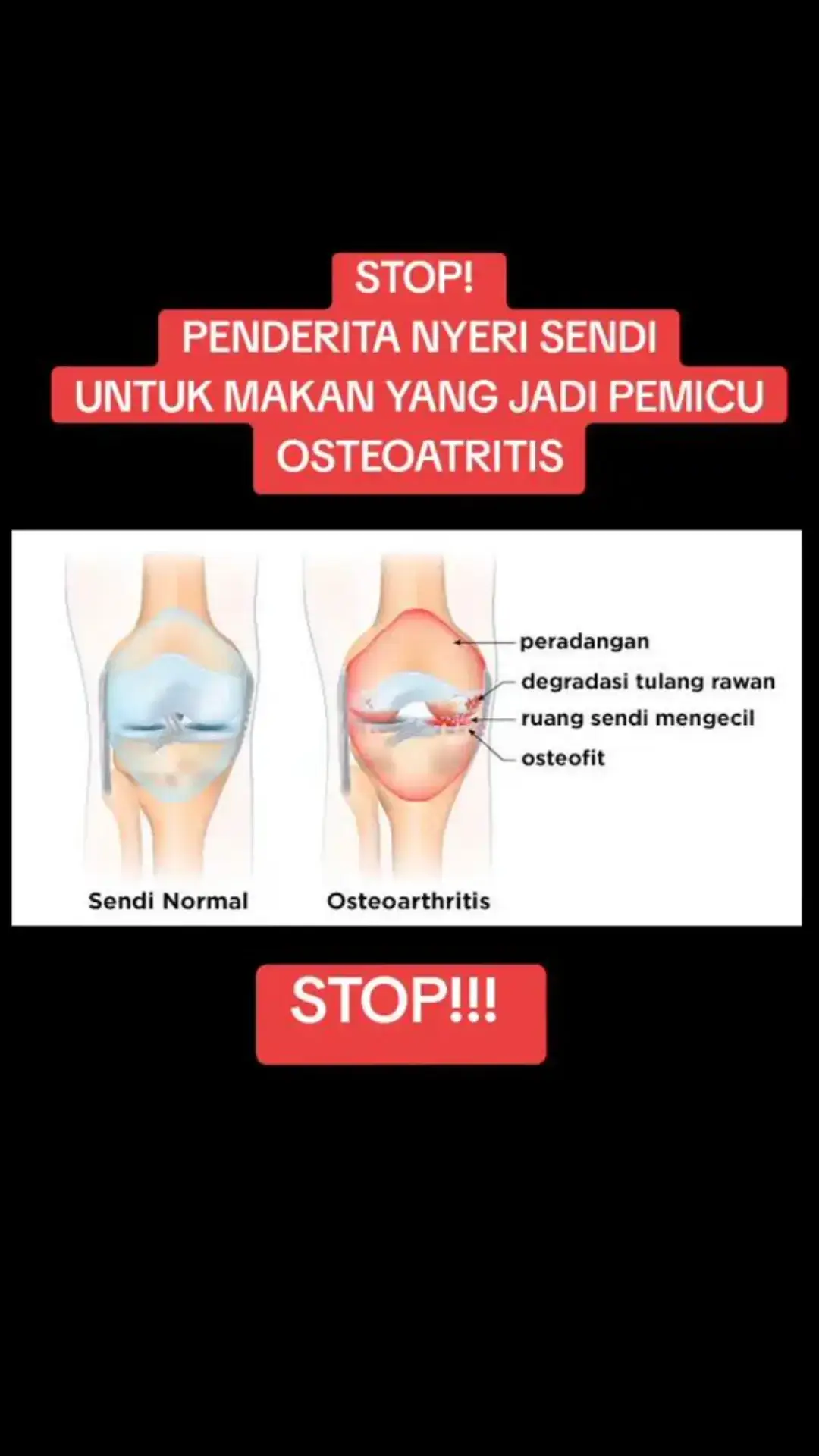 Penderita osteoarthritis sebaiknya menghindari makanan yang memicu peradangan karena peradangan dapat memperburuk kerusakarn sendi, meningkatkan nyeri, dan mempercepat degenerasi tulang rawan. Makanan yang tinggi gula, lemak jenuh, dan karbohidrat olahan dapat memicU respons inflamasi dalam tubuh, yang memperparah gejala osteoarthritis. Sebaliknya, makanan antiinflamasi seperti ikan berlemak, sayuran hijau, buah beri, dan kunyit dapat membantu mengurangi peradangan dan nyeri sendi. Jadi, penting untuk memilih makanan yang mendukung kesehatan sendi daripada yang memperburuk kondisinya. #fyp #fyp #foryou #fypp #fypage #fypppppppppppppppppppppp #rematik #sarafkejepit #nyerilutut #nyerisendi #lututsakit #pengapuran #travelwithlove #viral 
