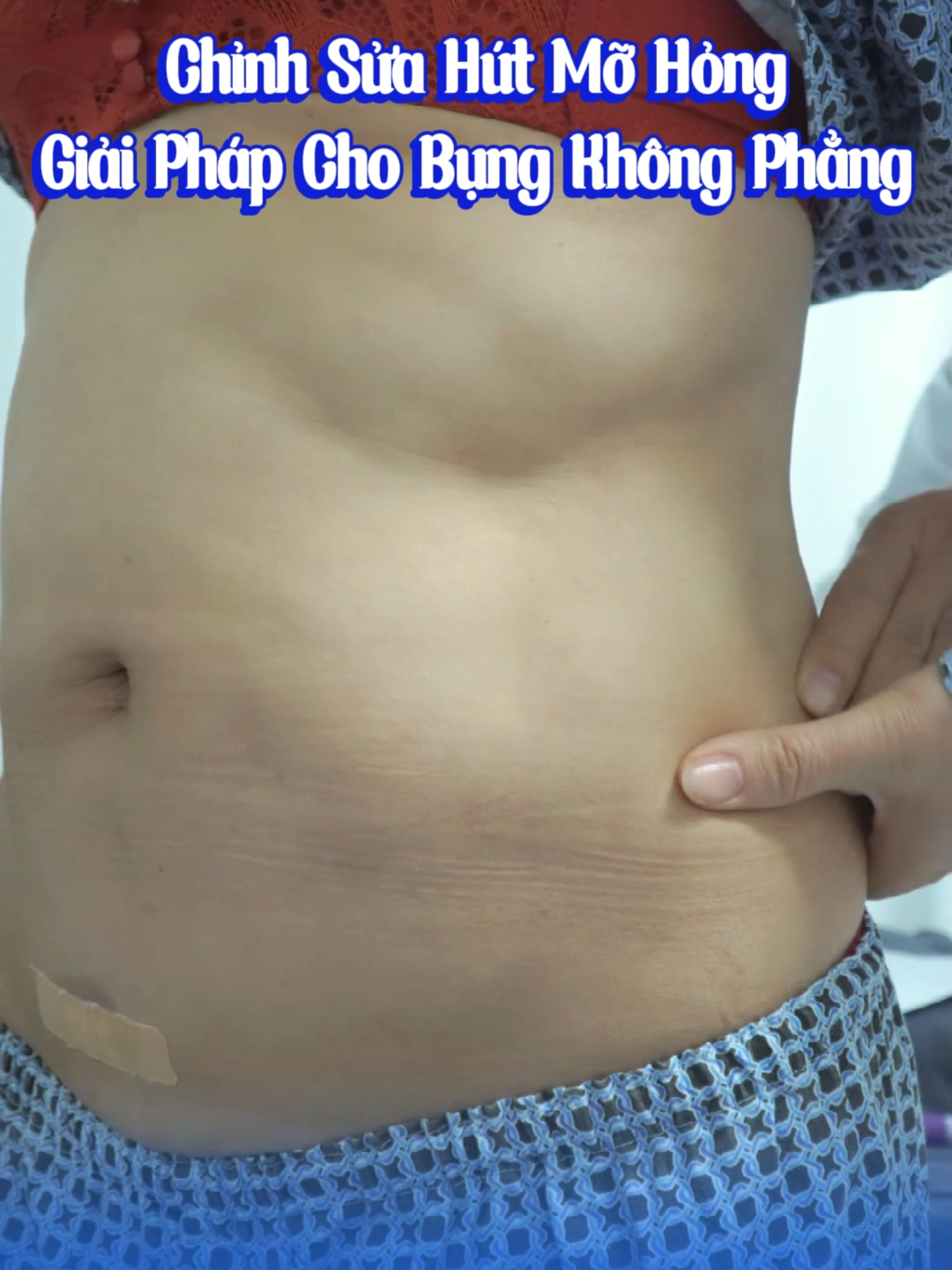 Chỉnh Sửa Hút Mỡ Hỏng: Giải Pháp Cho Bụng Không Phẳng Không Đều#drtrong_suckhoe_lamdep #hutmotaohinhthanhbung #xuhuong #taohinhthanhbung #hutmo #lamdep