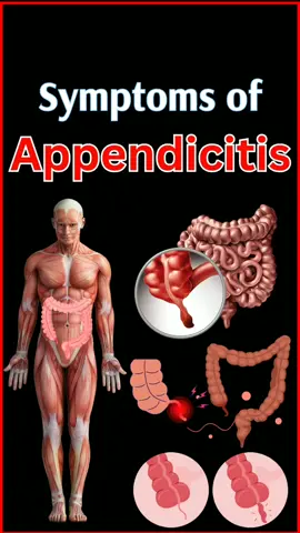 Common Symptoms of Appendicitis : Recognizing the Warning Signs #Appendicitis #AbdominalPain #coughing #sneezing #Appetite #LossofAppetite #Nausea #vomiting #stomach #Fever #Chills #appendix #gas #DigestiveIssues #Constipation #diarrhea #Bloating #FrequentUrination #PainfulUrination #irritability #eat #lethargy #Pregnant #Pregnantwomen #adults 