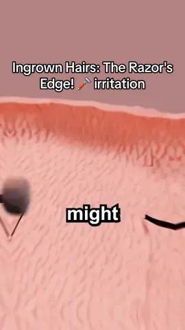 Ever wonder how shaving leads to those annoying #ingrownhairs ?🔬This animation reveals exactly how your razor can cause hairs to get trapped and irritate your skin! -𝐅𝐨𝐥𝐥𝐨𝐰 𝐟𝐨𝐫 𝐦𝐨𝐫𝐞 𝐟𝐚𝐬𝐜𝐢𝐧𝐚𝐭𝐢𝐧𝐠 𝐬𝐜𝐢𝐞𝐧𝐜𝐞 𝐟𝐚𝐜𝐭𝐬!🧠 #ingrownhair #shavingtips #shavinghacks #healthtips #healthtok #razorburn #skincaretips #skincareroutine #skincare #skincaretips #skincaretiktok #skincaretok #animation #3danimation #animatedstories #animatedtiktok #beautytips #beautyhacks #beautyhack #hairremoval #dermatology #fyp #foryoupage #ohsnapfacts #followme #follow #Science #education 