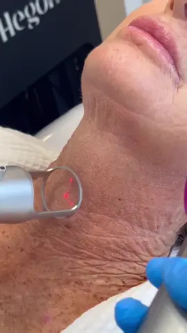 Laser de Co2 fracionado para retração e rejuvenescimento intenso de pescoço, colo e mãos.  #LaserCO2 #Beleza #Rejuvenescimento #Viraliza 