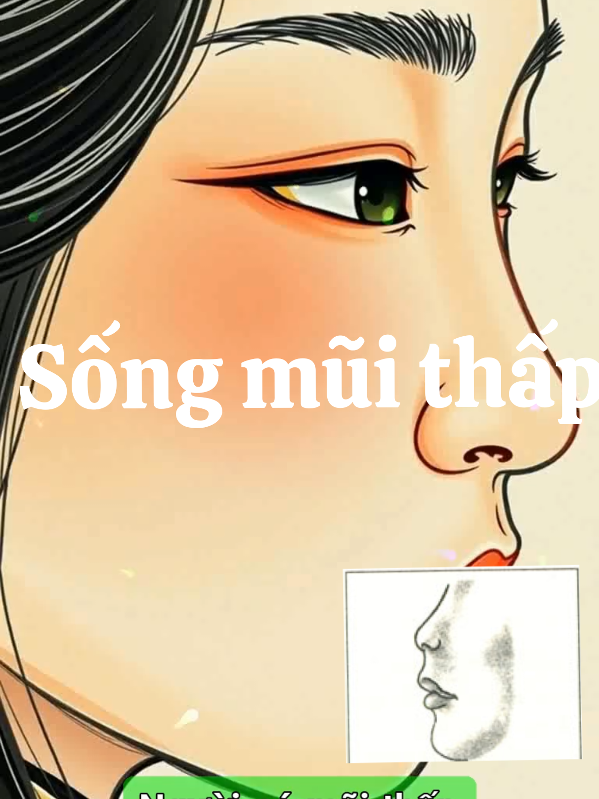 Trong nhân tướng học, mũi là trung tâm của khuôn mặt, được gọi là cung Tài Bạch, đại diện cho tài vận, năng lực tài chính và sự nghiệp ở tuổi trung niên. Người có mũi thấp – tức sống mũi không nhô cao, có thể bằng phẳng hoặc gần như chìm so với mặt – thường mang nhiều nét tính cách và số mệnh đặc trưng. Mũi thấp thường đi kèm với đầu mũi nhỏ, cánh mũi mỏng, sống mũi ngắn hoặc tẹt. Khi nhìn nghiêng, dáng mũi này thiếu độ nhô và đường cong tự nhiên. Về mặt tài lộc, người mũi thấp thường không mạnh về khả năng quản lý và tích lũy tiền bạc. Họ có thể kiếm tiền nhưng khó giữ, dễ bị hao hụt tài sản do quyết định sai lầm hoặc tin người quá mức. Tính cách của họ thiên về sự nhẹ nhàng, thụ động, thiếu chủ kiến nên khó tạo được đột phá trong sự nghiệp, thường chỉ phù hợp làm việc hỗ trợ hoặc đứng sau người khác. Vào độ tuổi trung niên – giai đoạn mà mũi biểu trưng – người mũi thấp nếu không có các nét tướng bổ trợ khác tốt như trán cao, cằm đầy, tai dày thì dễ gặp vận hạn, công việc chững lại, tài lộc kém phát triển. Về mặt hôn nhân, người có mũi thấp thường sống tình cảm, dễ rung động nhưng thiếu sự cứng cỏi để giữ gìn hạnh phúc lâu dài. Tình cảm của họ dễ đến nhanh và đi cũng nhanh, thiếu sự ổn định. Trong đời sống vợ chồng, họ thường ở thế yếu, dễ bị chi phối, hoặc phải chịu phần thiệt, đặc biệt là nữ giới nếu đi kèm mắt buồn, môi mỏng thì tình duyên dễ lận đận, muộn màng hoặc hôn nhân không bền vững. Tuy nhiên, người mũi thấp thường có tính cách hiền lành, biết nhẫn nhịn, dễ được người khác quý mến. Nếu biết chọn bạn đời mạnh mẽ, đáng tin cậy để bù đắp tính cách, biết học cách độc lập, chủ động trong công việc lẫn tình cảm thì hoàn toàn có thể cải thiện vận mệnh. Trong xã hội hiện đại, việc chăm sóc ngoại hình hay thẩm mỹ nhẹ để làm mũi hài hòa hơn cũng là một cách cải vận được nhiều người lựa chọn. Tóm lại, tuy không phải là tướng mũi giàu sang, quyền quý nhưng người mũi thấp nếu biết phát huy điểm mạnh, khắc phục nhược điểm thì vẫn có thể sống hạnh phúc và đủ đầy.