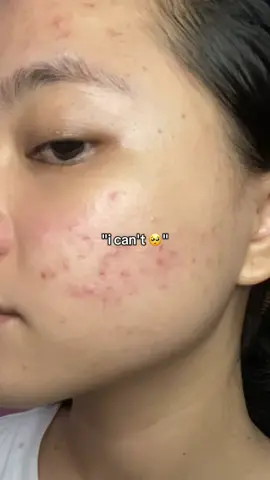 ❤️‍🩹 #acnejourney #skinupdate #skinjourney #fyp 