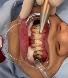 Lấy cao răng bằng công nghệ thổi cát!!! Tuyệt vời!!! #lấycaorăng #máythổicátnhakhoa 