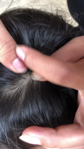 lice removal #omg #lice #liceremoval #treanding 😱🗯️