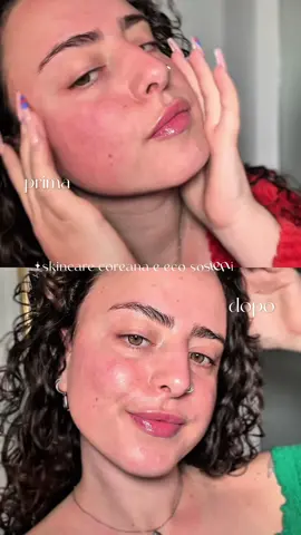 ho iniziato a provare le maschere di @noonchi.skincare e questo è il risultato subito dopo la maschere!!!  nel link in bio potete acquistare le maschere con uno sconto e la spedizione gratuita!!!🌼⭐️🫧🫧 #NoonChi #GlowByNoonChi #MyNoonChiRitual #NoonChiKBeauty #VeganSkincare #skincarecoreana #CleanBeauty #skincarecoreano  