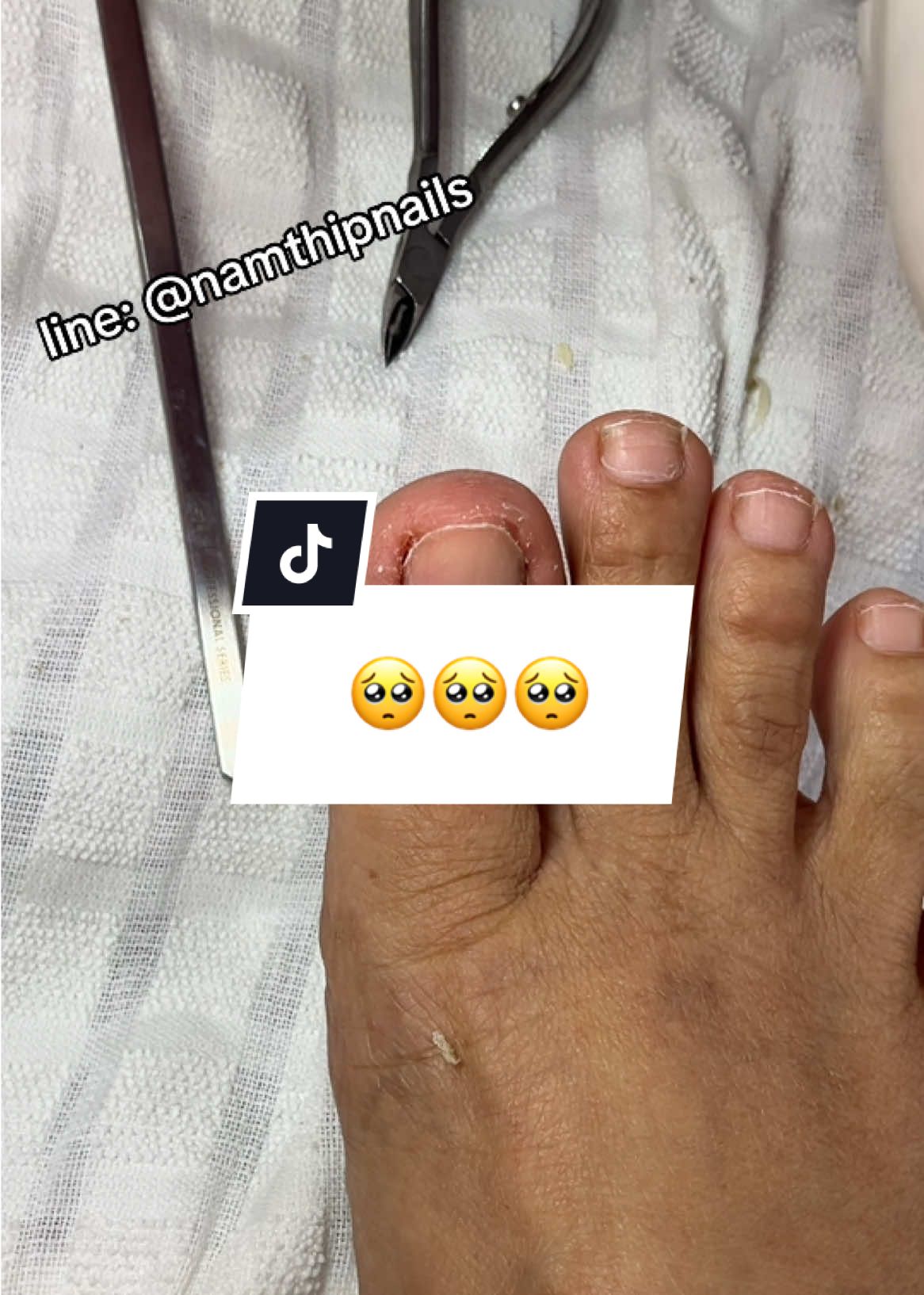 💓 #namthipnails #ตัดเล็บขบ #ตัดหนัง #ทำเล็บ #ร้านตัดเล็บขบ #ร้านตัดเล็บขบราม2 #ตัดเล็บ #เล็บขบ  #เล็บเชื้อรา Fb : namthipnails  Line : @namthipnails  นัมเบอร์วัน8 ตลาดม.ราม2  กทม  Map: namthipnails  https://goo.gl/maps/JmwpCKLfKwmhKGK96  ร้านเปิดทุกวัน เวลา12.00น-22.00น.