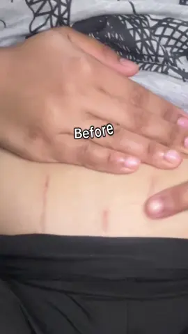 Original Pregnancy cream Anti-Stretch Mark cream free shipping Remover Aichun Beauty Anti-Stretch Marks Cream Natural Pregnancy Moisturizer repair All Skin Types #stretchmark #antistretchmarkcream #antistretchmark #stretchmarkremover #stretchmarkremoval 